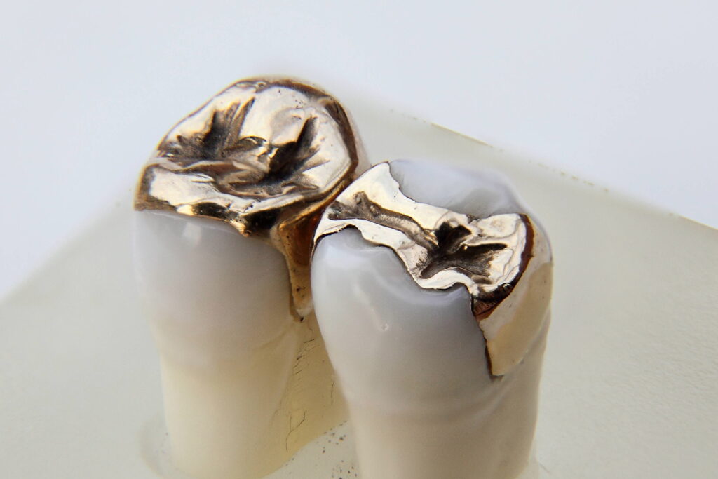 Dental inlays