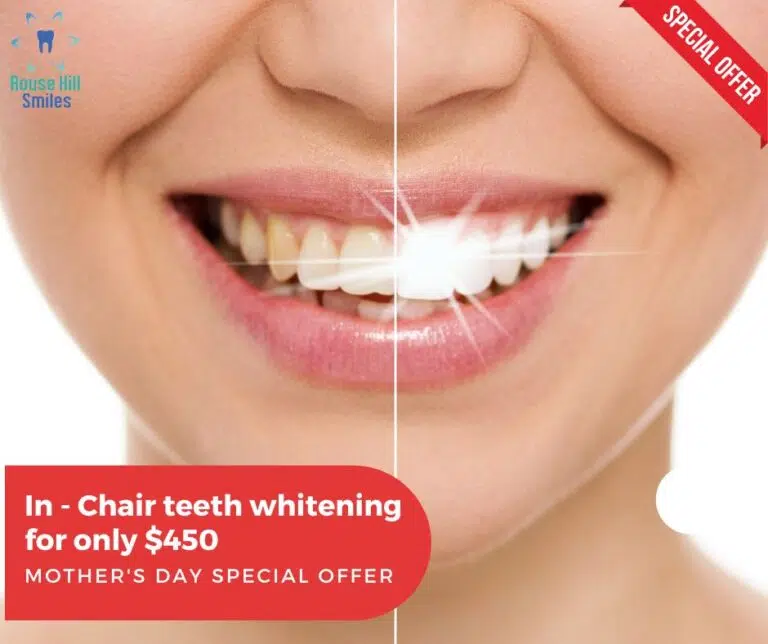 teeth whitening