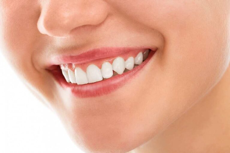 Veneers