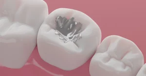 Dental Fillings