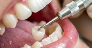 Dental Crowns