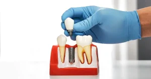 Denture Implants