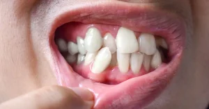 Crooked Teeth