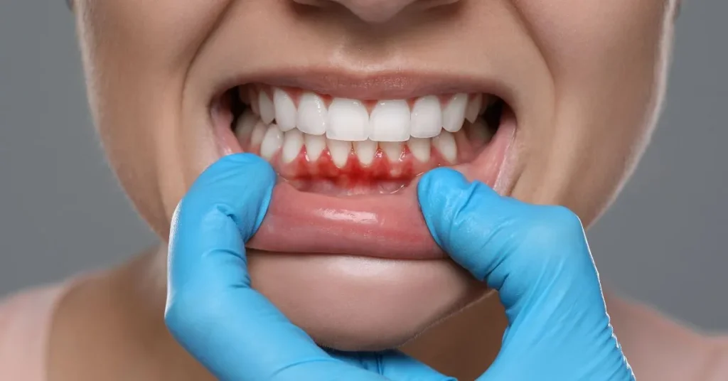 Gum grafts
