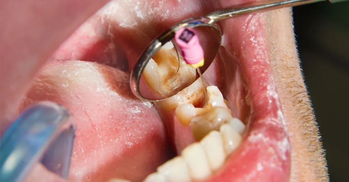 Root Canal Treatment