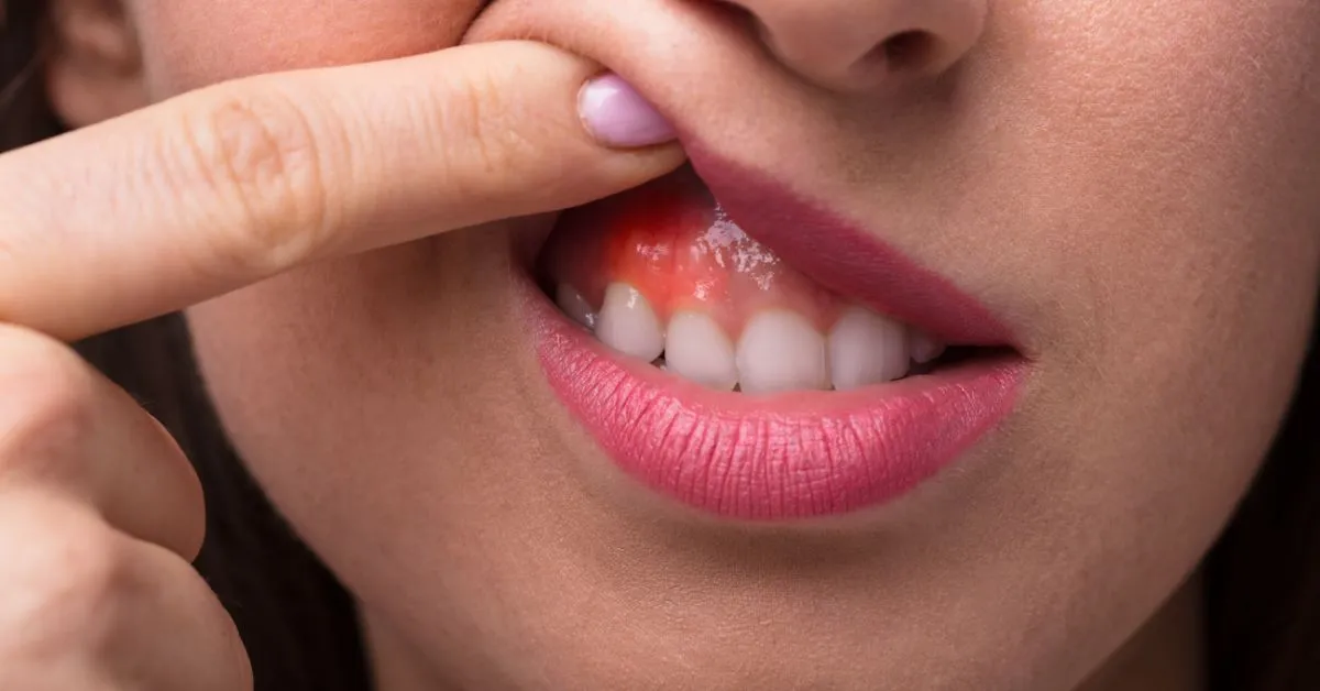 Gum Swelling