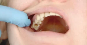 Cavities