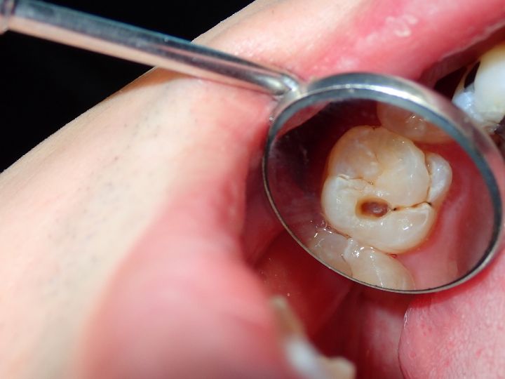 cavities