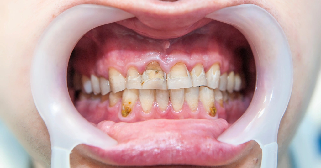 dental erosion