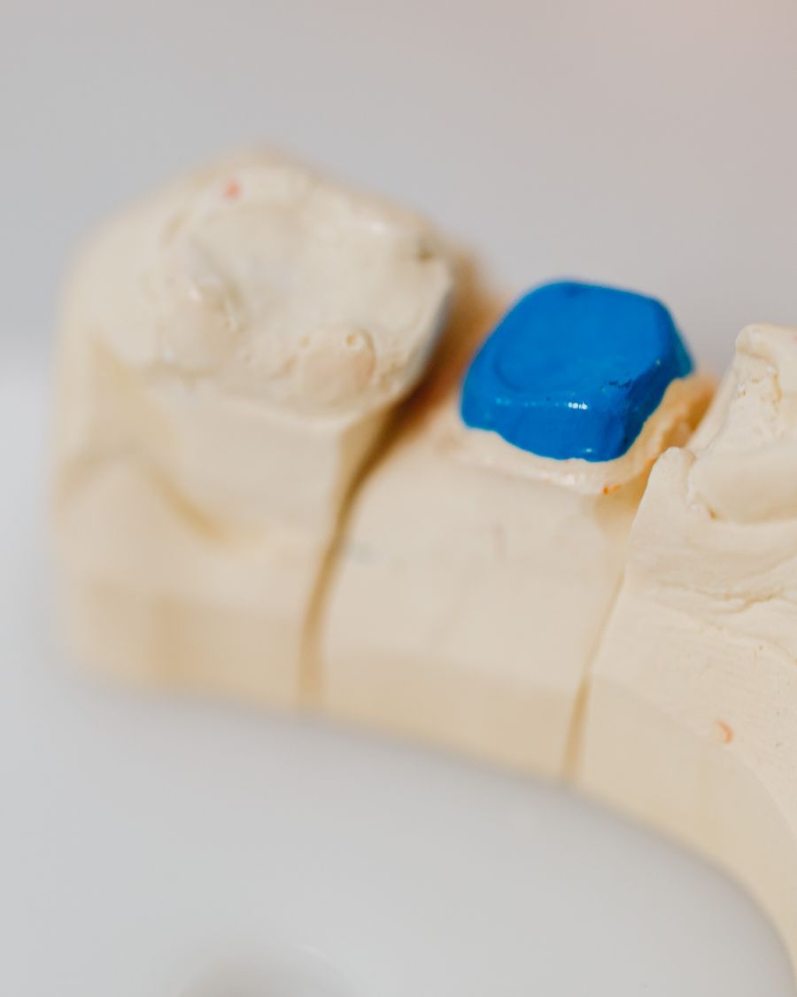 Dental jaw model showing a tooth-coloured filling