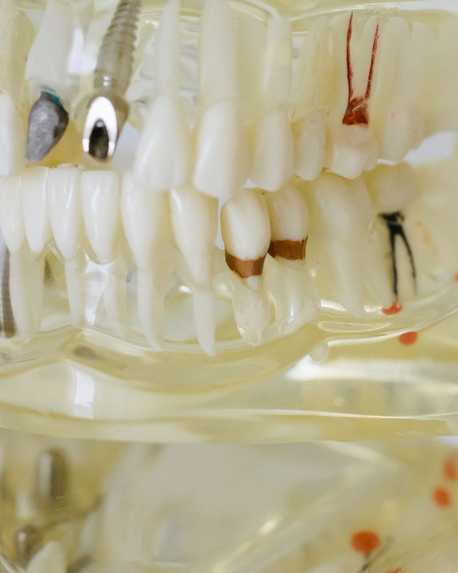 Dental model showing fillings and restorations